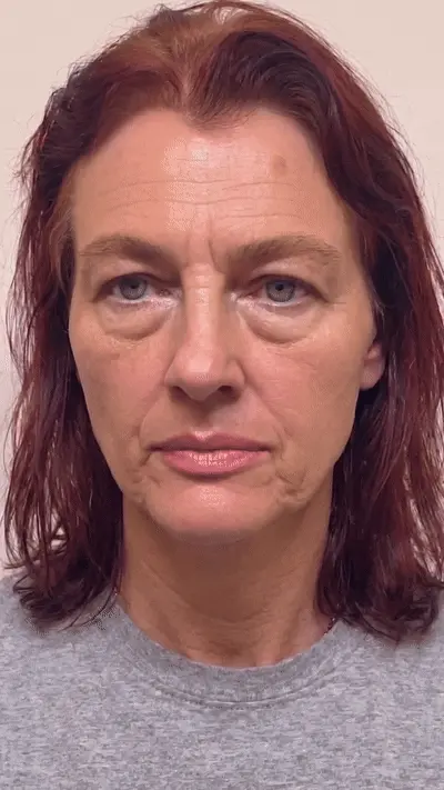 Margaret before and after eye treatment