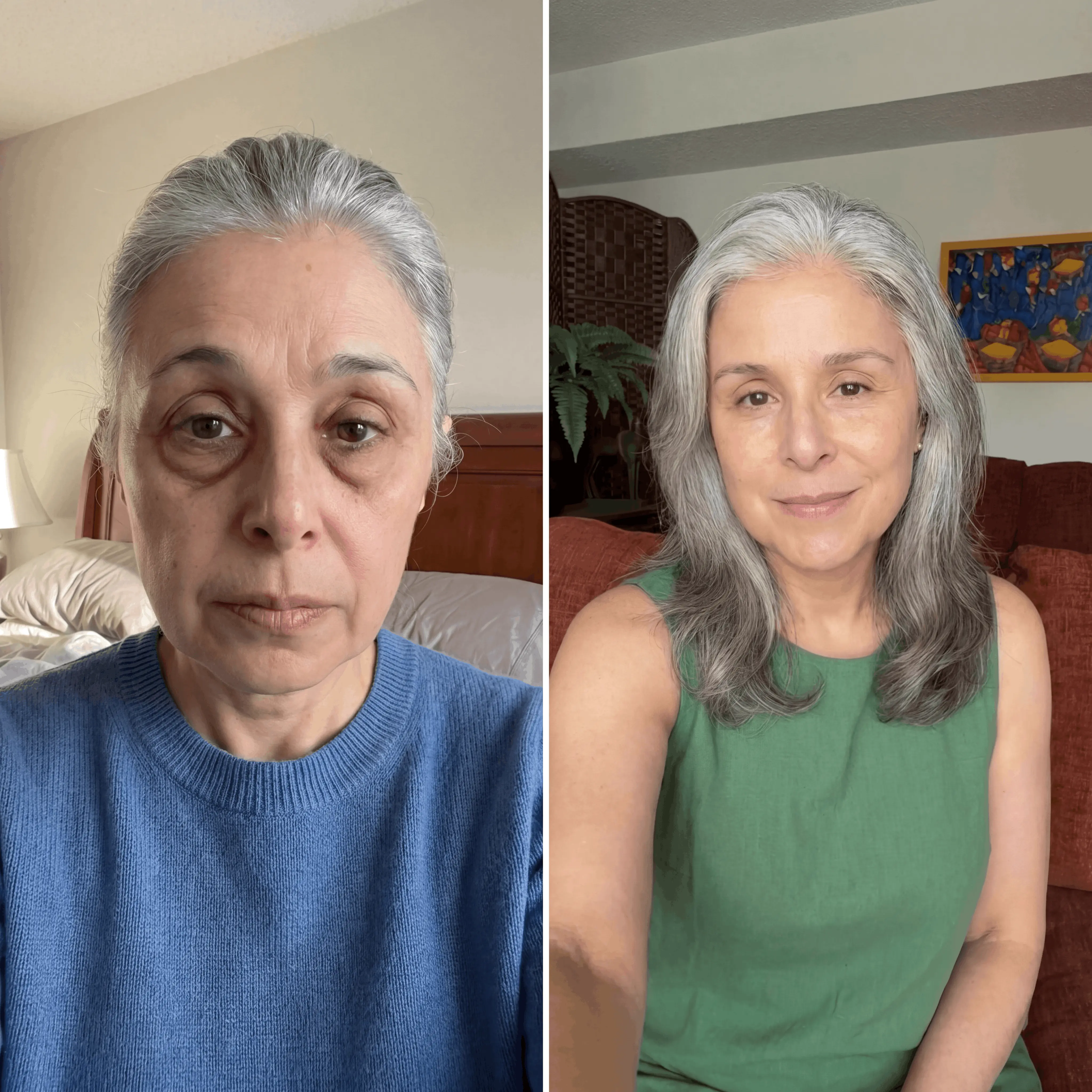 Patricia before and after eye treatment