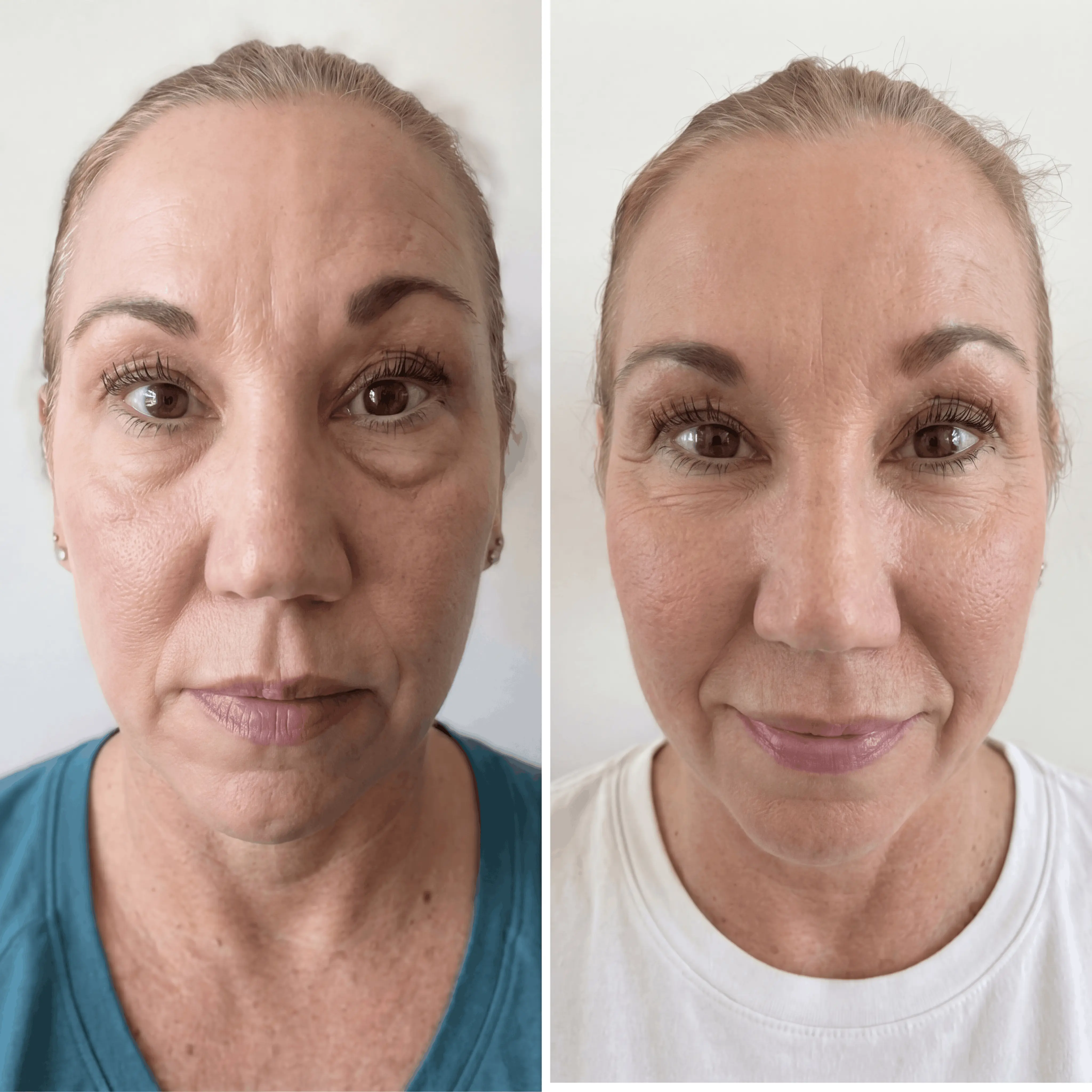 Before and After eye bags treatment