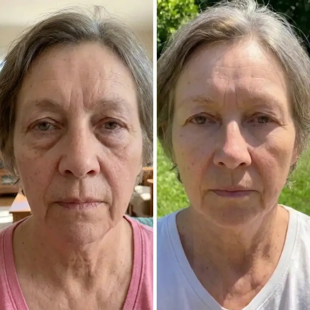 Judith before and after eye treatment